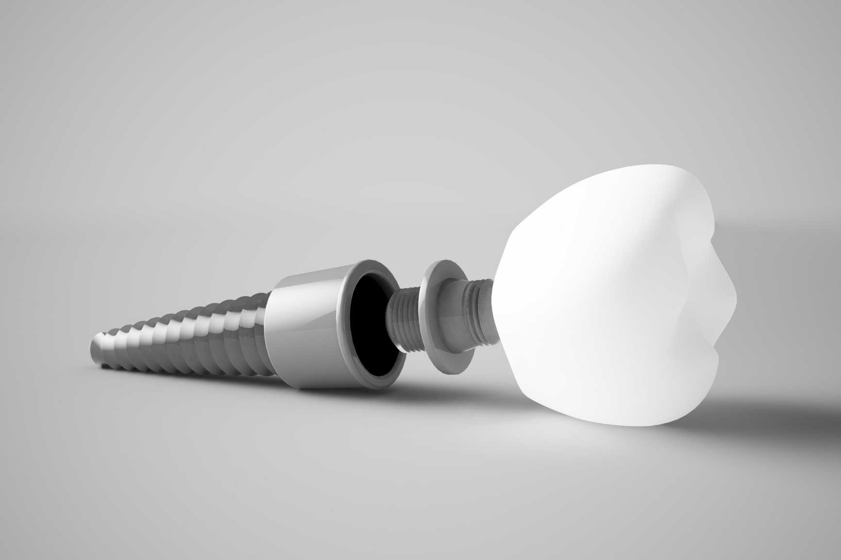 Diş İmplantı Hakkında Sorulan 10 soru