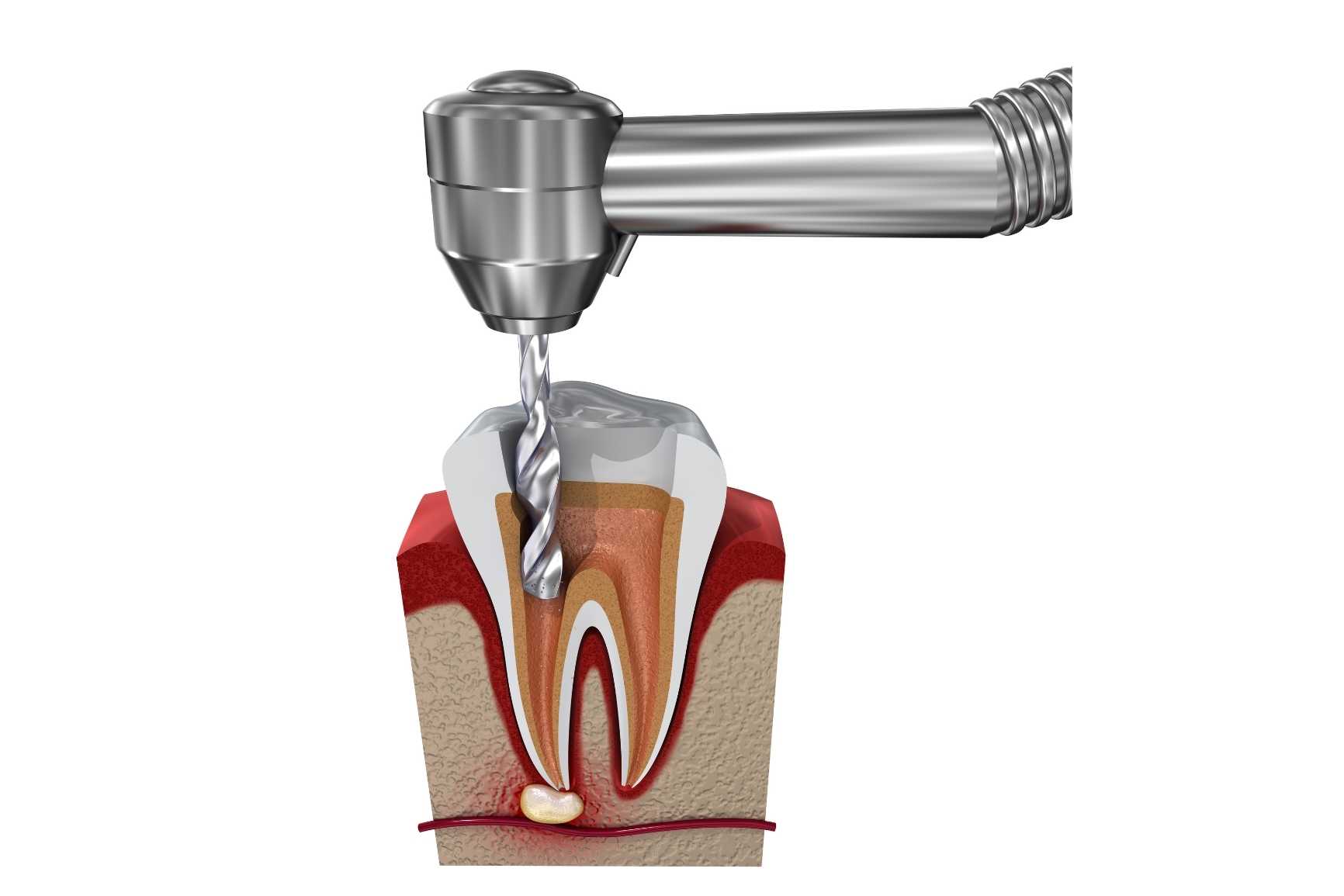 endodonti nedir