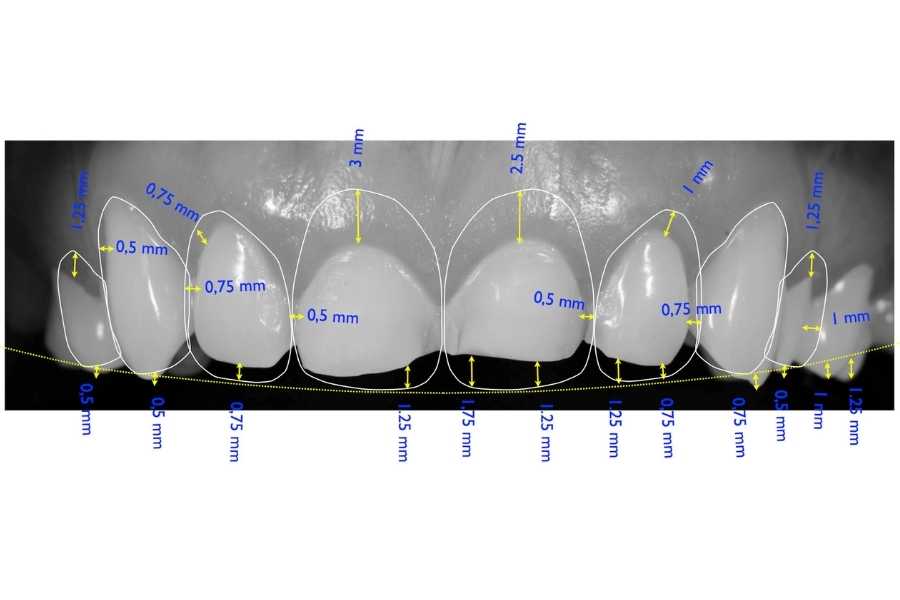 Estetik Gülüş Tasarımı