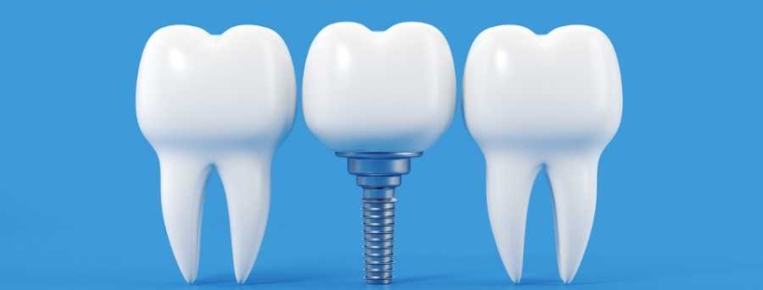 İmplant Tedavisi Aşamaları