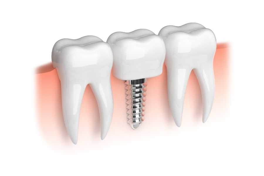İmplant Tedavisi Aşamaları