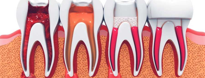 Kanal Tedavisi Nedir