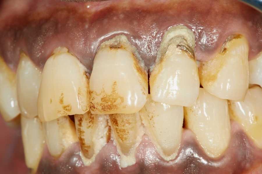 Periodontoloji Nedir ve Nasıl Uygulanır
