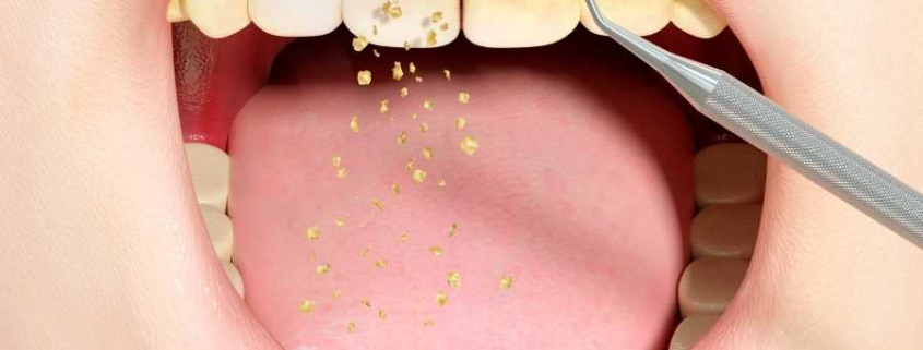 Periodontoloji Nedir ve Nasıl Uygulanır