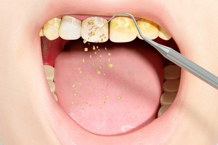 Periodontoloji Nedir ve Nasıl Uygulanır