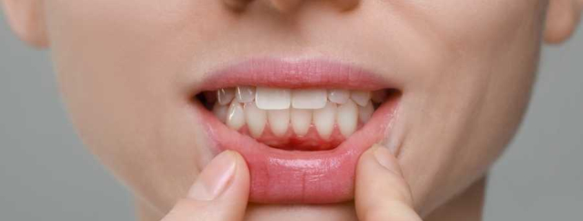 Ağız ve Diş Eti Hastalıkları