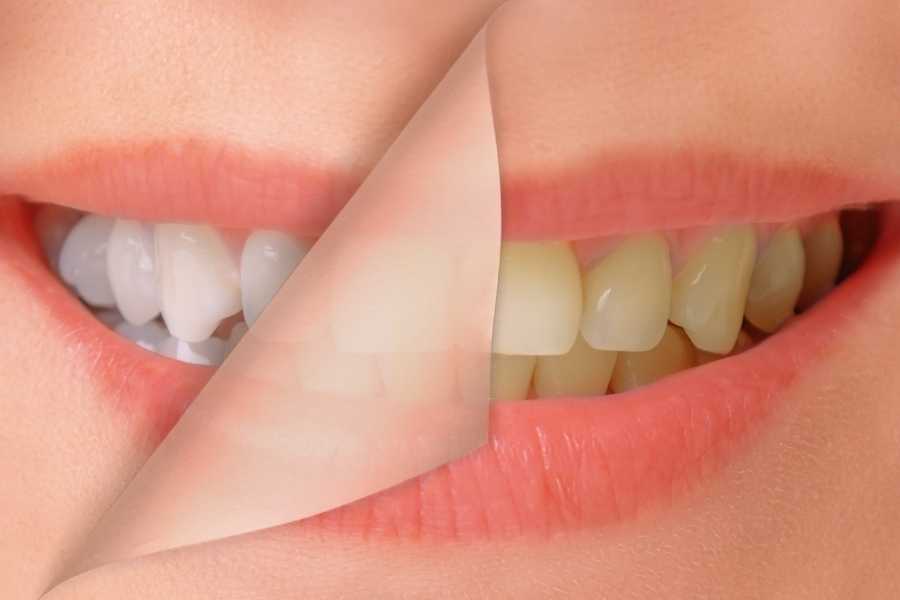 Kalıcı Diş Beyazlatma