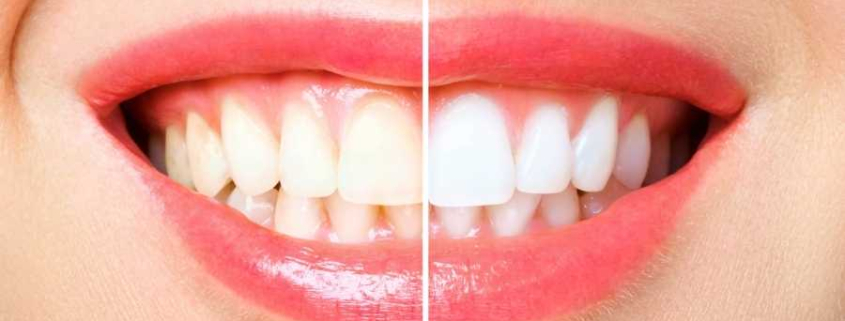 Kalıcı Diş Beyazlatma
