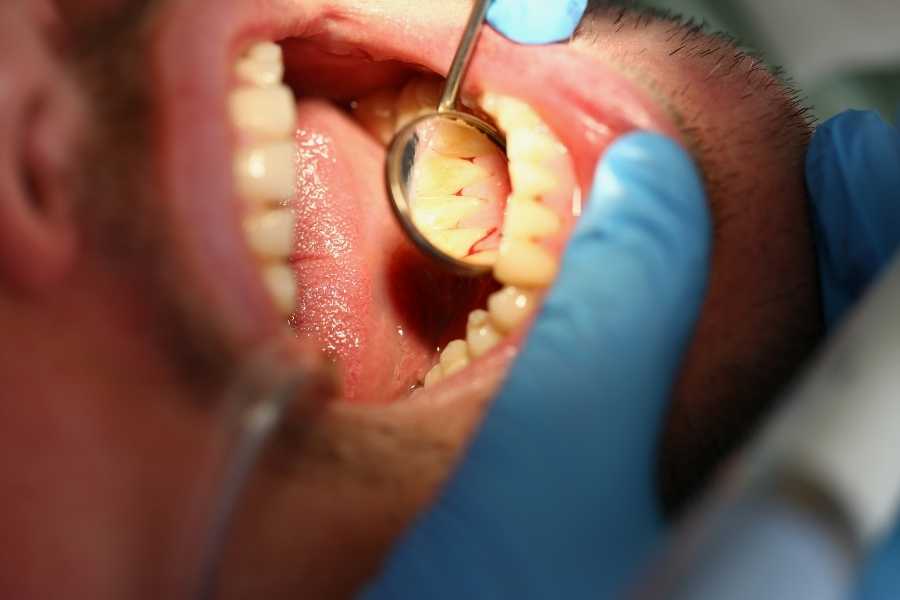 Periodontoloji ve Genel Sağlık İlişkisi