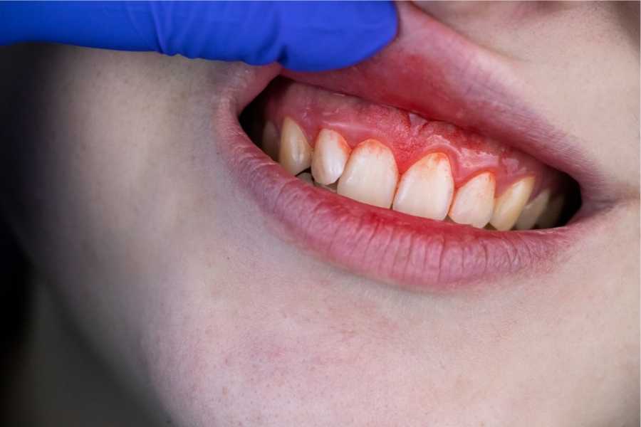 Periodontoloji ve Genel Sağlık İlişkisi