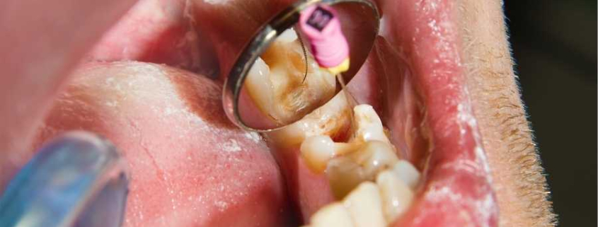 Endodonti Diş Tedavisi