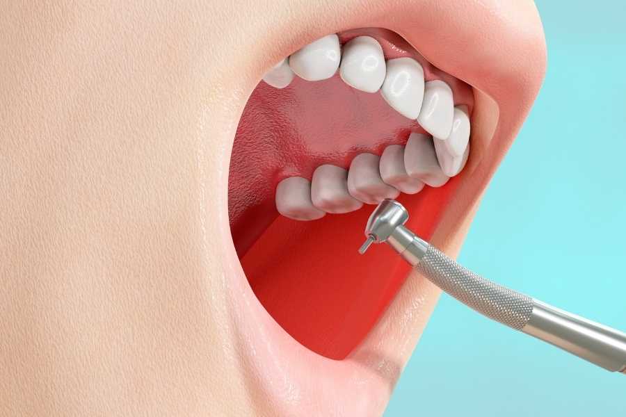 Periodontoloji Tedavisi Nasıl Yapılır