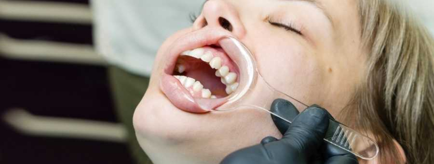 Periodontoloji Tedavisi Nasıl Yapılır